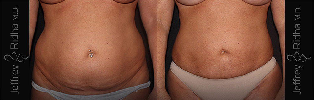 Liposuction Saratoga, NY